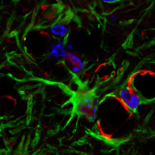 Cellule d’astrocyte réactive dans la moelle épinière atteinte de SLA
