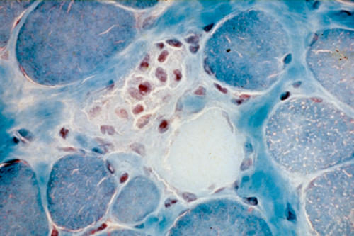 Lésions nécrotiques (mort cellulaire) de fibres musculaires constituées de myofibrilles
