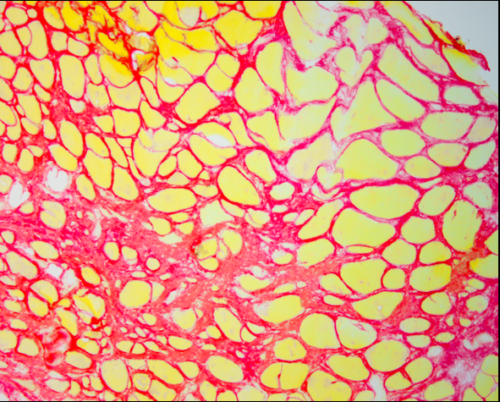 Coloration rouge sirius pour détecter la fibrose musculaire. Fibres en jaune, fibrose en rouge©BENSALAH/MURAINE