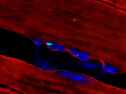 Agrégat de PABPN1 (vert) dans des noyaux (bleu) de fibres musculaires (rouge) chez un patient OPMD. ©TROLLET